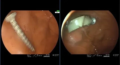 5 giờ nghẹt thở cứu bé trai sơ sinh mang khối u não xuất huyết