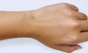 5 loại ung thư di truyền thường gặp