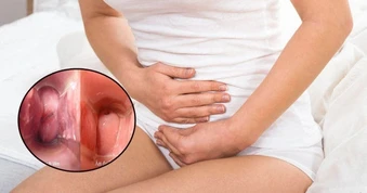 6 nguyên nhân ít ngờ tới khiến viêm âm đạo tái phát nhiều lần