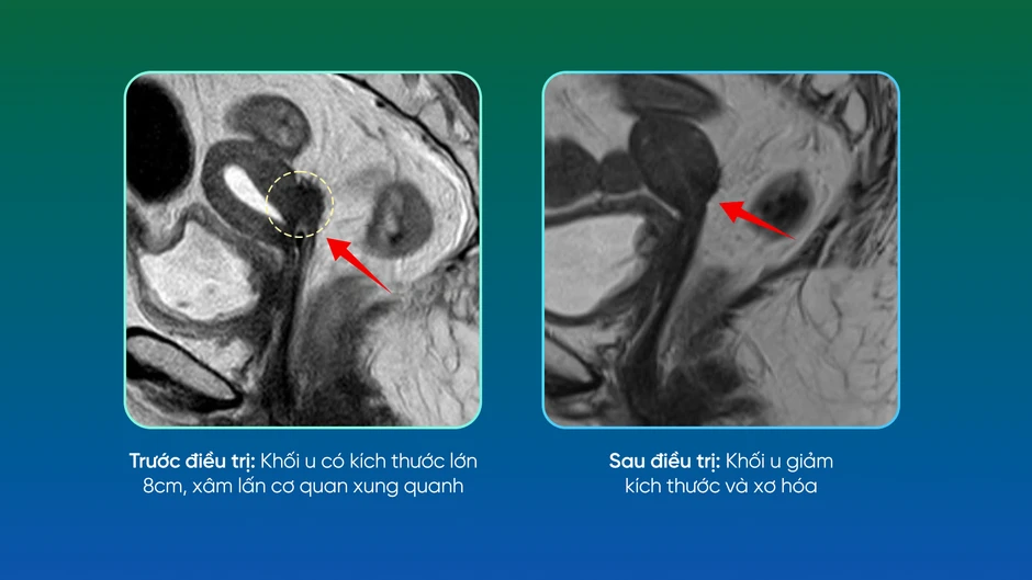 6 tuần kiên trì làm một việc giúp khối u 8cm gần như biến mất: Bác sĩ thốt lên "kỳ tích" 6 tuần kiên trì làm một việc giúp khối u 8cm gần như biến mất: Bác sĩ thốt lên "kỳ tích"