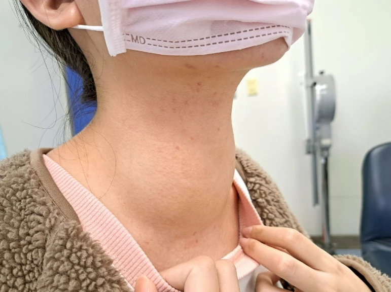 8 người 1 nhà cùng mắc ung thư, bác sĩ vạch trần 5 thay đổi đầu tiên khi tuyến giáp bị khối u "xâm chiếm" 8 người 1 nhà cùng mắc ung thư, bác sĩ vạch trần 5 thay đổi đầu tiên khi tuyến giáp bị khối u "xâm chiếm"