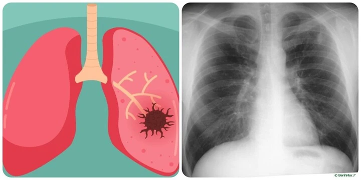 9 dấu hiệu ung thư phổi giai đoạn đầu