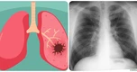 9 dấu hiệu ung thư phổi giai đoạn đầu