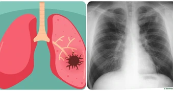 9 dấu hiệu ung thư phổi giai đoạn đầu