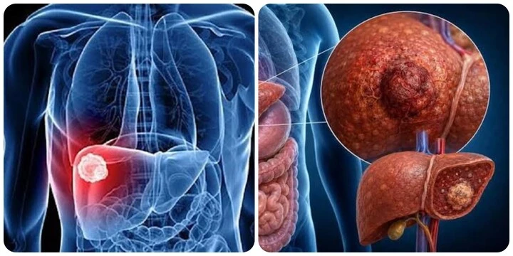 9 triệu chứng ung thư gan giai đoạn đầu 9 triệu chứng ung thư gan giai đoạn đầu