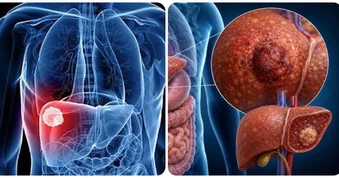 9 triệu chứng ung thư gan giai đoạn đầu