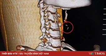 Áp xe cổ do xương cá mắc suốt nhiều tháng