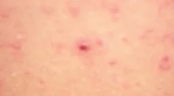 Ba người tử vong do virus Hanta, Bộ Y tế khuyến cáo 5 biện pháp phòng bệnh