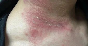 Bác sĩ Bệnh viện Bạch Mai hướng dẫn 2 bước xử lý viêm da do kiến ba khoang