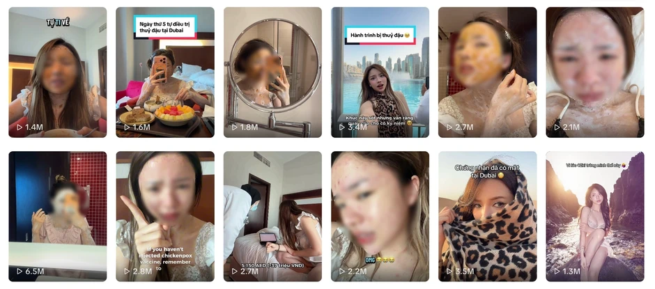 Bác sĩ cảnh báo bệnh trái rạ sau vụ TikToker Chany mắc thủy đậu ở Dubai Bác sĩ cảnh báo bệnh trái rạ sau vụ TikToker Chany mắc thủy đậu ở Dubai