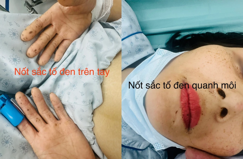 Bác sĩ cảnh báo: Xuất hiện 'nốt ruồi' ở bàn tay, quanh miệng có thể là dấu hiệu của BỆNH HIỂM NGHÈO Bác sĩ cảnh báo: Xuất hiện 'nốt ruồi' ở bàn tay, quanh miệng có thể là dấu hiệu của BỆNH HIỂM NGHÈO