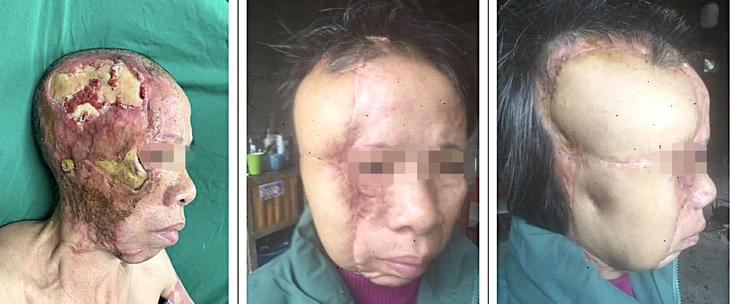 Bác sĩ kéo những 'đường mạch' hồi sinh cuộc đời người di chứng bỏng Bác sĩ kéo những 'đường mạch' hồi sinh cuộc đời người di chứng bỏng