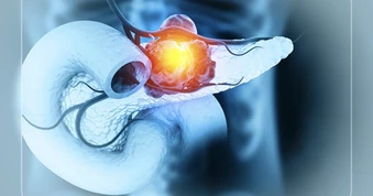 Bác sĩ ngoại tổng quát nói thẳng: Ung thư tuyến tụy dễ bị bỏ qua nếu bạn không biết 4 dấu hiệu này