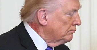 Bác sĩ Nhà Trắng lên tiếng về vết đỏ lạ trên cổ Tổng thống Trump
