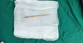 Bác sĩ sốc khi phát hiện chiếc tăm tre cắm trong tim bé trai 13 tuổi