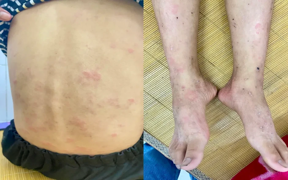 Ban nhiễm khuẩn ở trẻ em: Đừng chủ quan khi trẻ nổi ban, ngứa kéo dài Ban nhiễm khuẩn ở trẻ em: Đừng chủ quan khi trẻ nổi ban, ngứa kéo dài