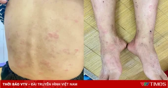 Ban nhiễm khuẩn ở trẻ em: Đừng chủ quan khi trẻ nổi ban, ngứa kéo dài