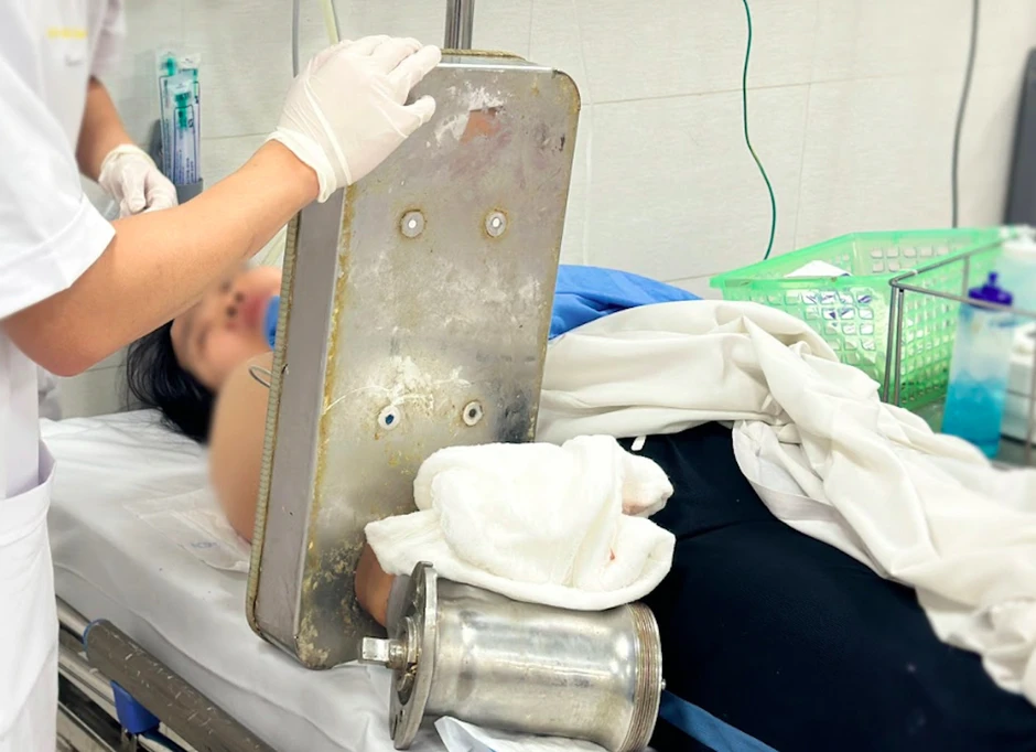 Bàn tay mắc kẹt trong máy xay thịt, người phụ nữ trẻ phải cắt cụt chi