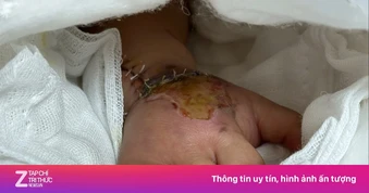 Báo động đỏ cứu bàn tay đứt lìa cho trẻ 2 tuổi