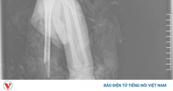 Bé 4 tuổi đứt rời cánh tay vì áo chống nắng cuốn vào bánh xe máy