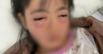 Bé 5 tuổi đi cấp cứu sau khi chơi thổi bong bóng xà phòng