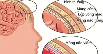 Bé 5 tuổi tử vong do viêm màng não mủ, lấy mẫu xét nghiệm 35 trẻ cùng lớp