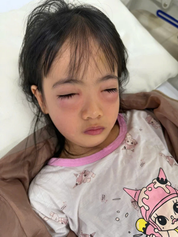 Bé gái 5 tuổi bị viêm kết mạc dị ứng sau khi chơi thổi bong bóng xà phòng Bé gái 5 tuổi bị viêm kết mạc dị ứng sau khi chơi thổi bong bóng xà phòng