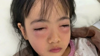 Bé gái 5 tuổi bị viêm kết mạc dị ứng sau khi chơi thổi bong bóng xà phòng