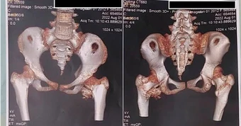 Bé gái 12 tuổi mắc hội chứng người hóa đá cực hiếm