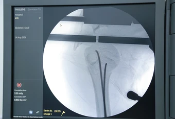 Bé gái 14 tuổi gãy xương cánh tay sau tai nạn xe đạp điện được phẫu thuật qua hai vết mổ nhỏ