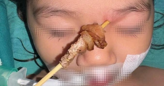 Bé gái 2,5 tuổi bị que xiên thịt đâm xuyên hốc mắt