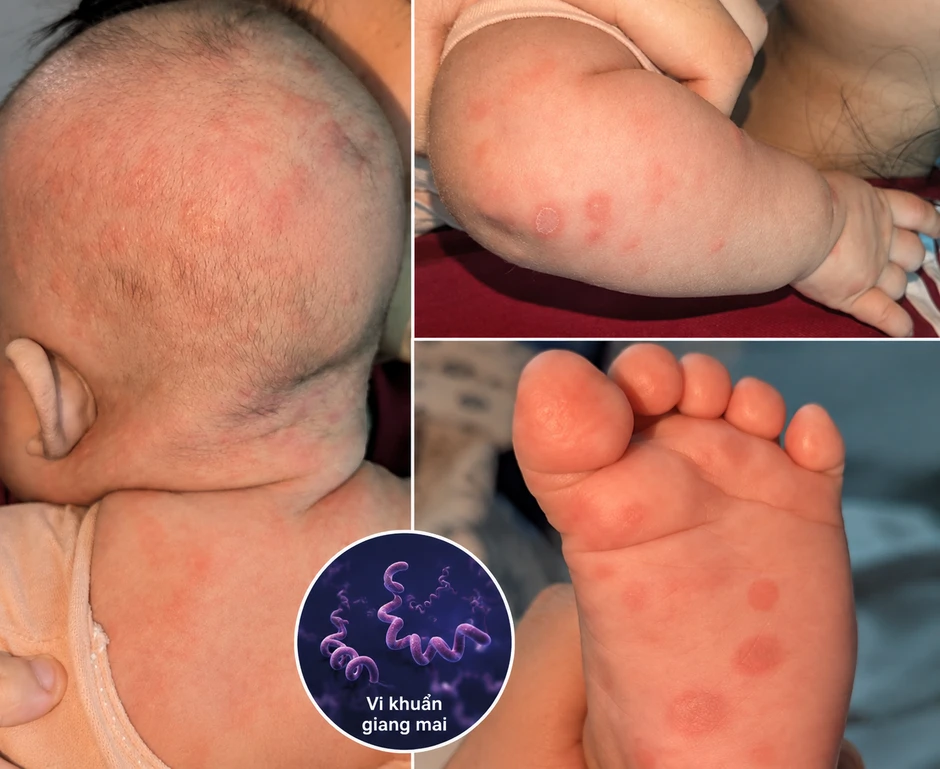 Bé gái 2 tháng tuổi phát hiện mắc giang mai khi đi khám da
