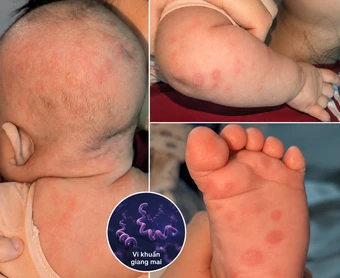Bé gái 2 tháng tuổi phát hiện mắc giang mai khi đi khám da
