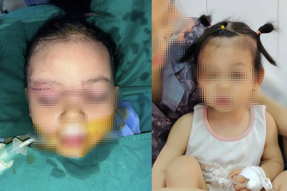 Bé gái 22 tháng tuổi bị chó cắn tổn thương nghiêm trọng khuôn mặt Bé gái 22 tháng tuổi bị chó cắn tổn thương nghiêm trọng khuôn mặt