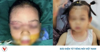 Bé gái 22 tháng tuổi bị chó cắn tổn thương nghiêm trọng khuôn mặt