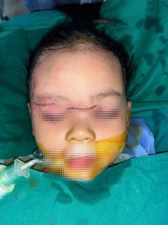 Bé gái 22 tháng tuổi tổn thương nghiêm trọng vùng mặt do chó cắn Bé gái 22 tháng tuổi tổn thương nghiêm trọng vùng mặt do chó cắn