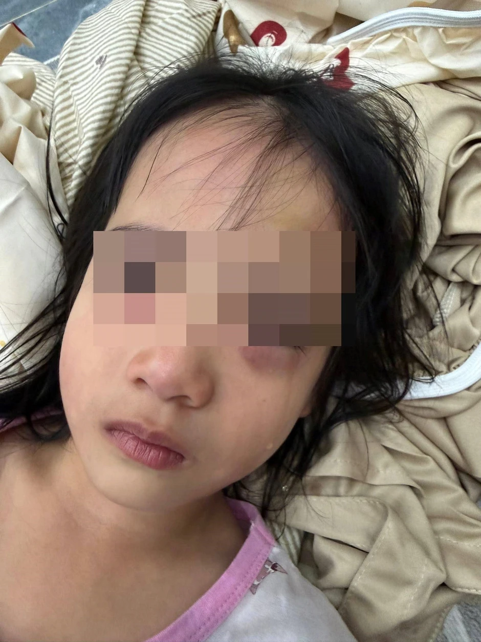 Bé gái 5 tuổi nhập viện, mắt sưng vù sau khi chơi bong bóng xà phòng Bé gái 5 tuổi nhập viện, mắt sưng vù sau khi chơi bong bóng xà phòng