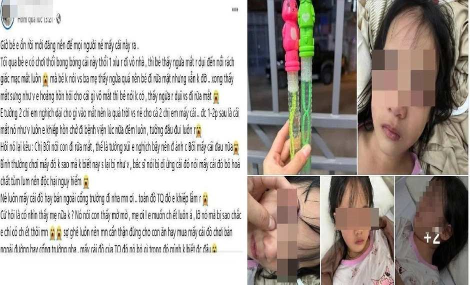 Bé gái 5 tuổi nhập viện, mắt sưng vù sau khi chơi bong bóng xà phòng Bé gái 5 tuổi nhập viện, mắt sưng vù sau khi chơi bong bóng xà phòng