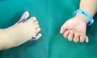 Bé gái có 26 ngón tay chân - Báo TinVina