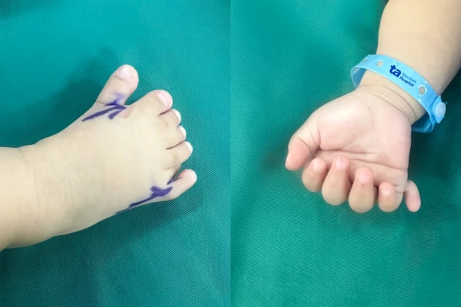 Bé gái có 26 ngón tay chân - Báo TinVina Bé gái có 26 ngón tay chân - Báo TinVina