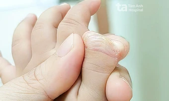 Bé gái có hai ngón cái trên một bàn tay - Báo TinVina