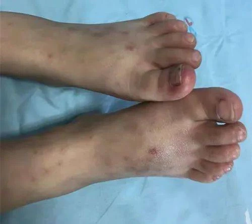 Bé gái lớp 5 đã mắc bệnh gút, bác sĩ nói thẳng: 5 món vạn người mê này là "đồng phạm" Bé gái lớp 5 đã mắc bệnh gút, bác sĩ nói thẳng: 5 món vạn người mê này là "đồng phạm"
