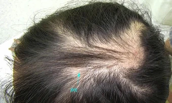 Bé gái mắc hội chứng nghiện giật tóc - Báo TinVina