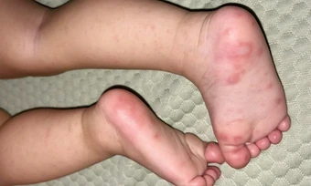Bé gái mắc tay chân miệng kèm viêm phế quản - Báo TinVina