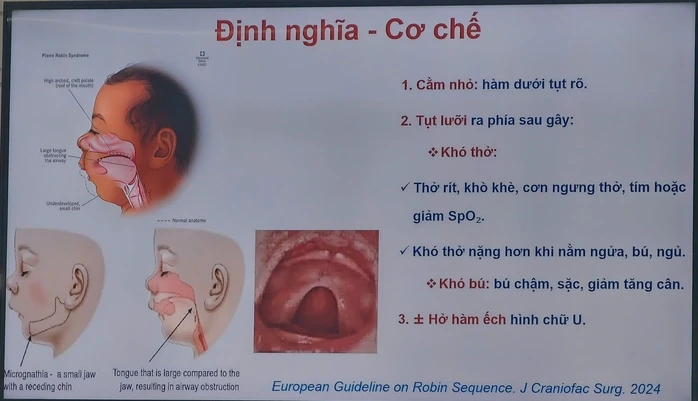 Bé gái suýt nguy kịch vì hội chứng Pierre Robin hiếm gặp Bé gái suýt nguy kịch vì hội chứng Pierre Robin hiếm gặp