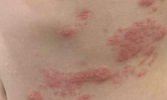 Bé trai 13 tuổi mắc zona thần kinh - Báo TinVina