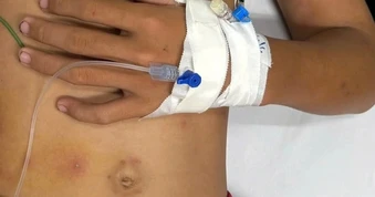 Bé trai 14 tuổi bị ong vò vẽ đốt 55 vết