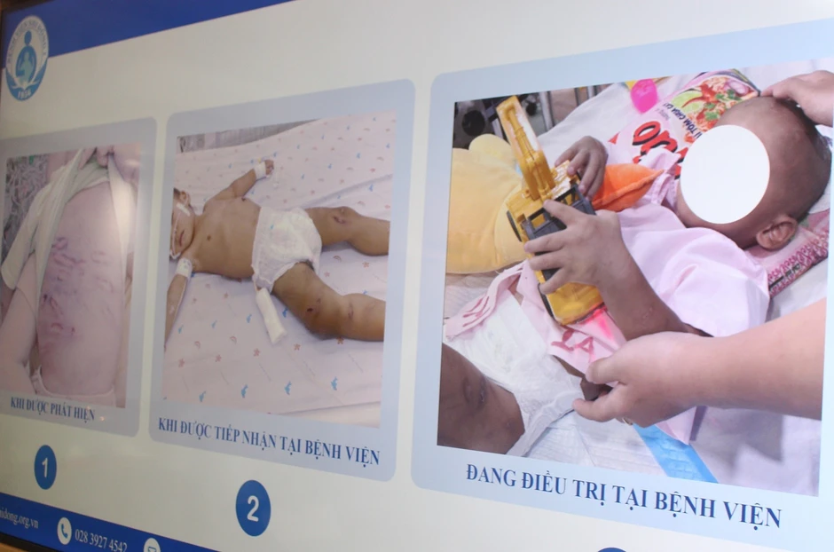 Bé trai 2 tuổi bị bạo hành nhiều đêm giật mình khóc gọi mẹ