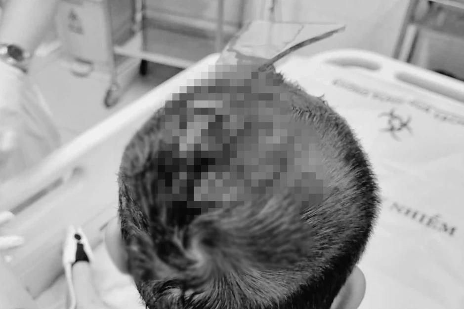 Bé trai 4 tuổi ở TPHCM bị mảnh kính bể cá tại nhà găm vào đầu