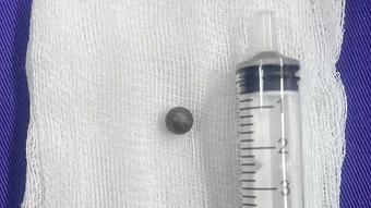 Bé trai bị bi sắt đâm xuyên mắt, nằm sát nền sọ